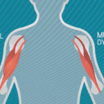 Muscular Dystrophy